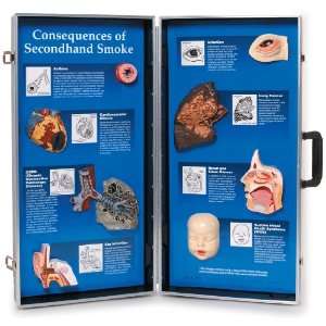 3B Scientific W43112 Consequences of Secondhand Smoke 3D Display, 28 