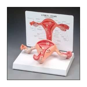 Anatomical Chart Company   Uterus, Ovaries Model w/Pathologies  